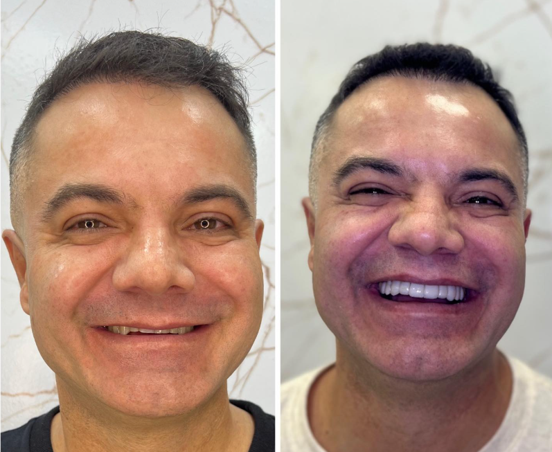 Antes e Depois - Transformação 8